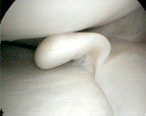 kneearthroscopy-image2