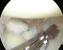 kneearthroscopy-image3