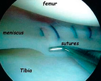 kneearthroscopy-image4