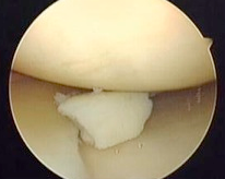 kneearthroscopy-image7