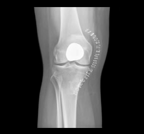 patellofemoral-image1 patellofemoral