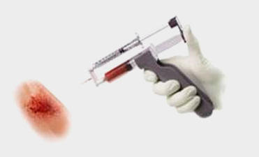 plateletrichplasma-image1