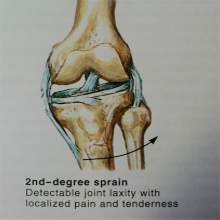 Soccer Knee Injuries - Treatments | Advanced Knee Care