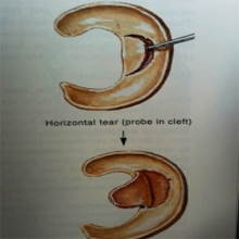 meniscal